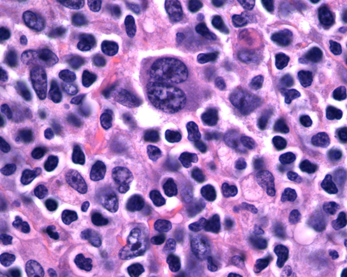 A 46-year-old smoker presents to your office with a three week history of low-grade fever, weakness and neck swelling. Biopsy of the affected tissue reveals the following histologic findings:   An abnormality in which of the following tissues is most likely responsible for this patient's symptoms? A) Respiratory epithelium B) Thyroid gland C) Lymphoid tissue D) Myeloid precursors E) Skin epithelium