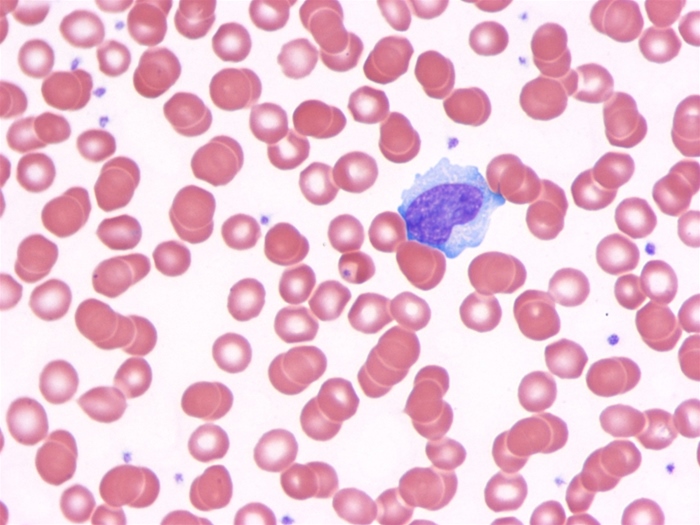A 16-year-old previously healthy boy is brought to the office due to fever, malaise, and sore throat.  The patient says that he gets tired even by simply getting out of bed.  Physical examination shows palatal petechiae, cervical lymphadenopathy, and splenomegaly.  His peripheral blood smear is shown in the image below.   Horse erythrocytes agglutinate when exposed to the patient's serum.  The agent causing this patient's disease is most strongly associated with which of the following malignancies? A) Acute myeloid leukemia B) Cervical carcinoma C) Hepatocellular carcinoma D) Kaposi sarcoma E) Mucosa-associated lymphoid tissue tumor F) Multiple myeloma G) Nasopharyngeal carcinoma