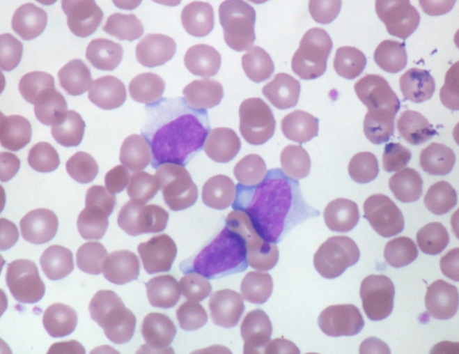 A 15-year-old girl is evaluated due to persistent fever, fatigue, and sore throat.  Physical examination reveals splenomegaly and symmetric posterior cervical lymphadenopathy.  Peripheral blood smear results are shown in the image below:   The atypical cells seen here are most likely an activated form of which of the following? A) CD4<sup>+ </sup>Helper lymphocytes B) CD8<sup>+ </sup>Cytotoxic lymphocytes C) CD14<sup>+ </sup>Monocytes D) CD21<sup>+ </sup>Lymphocytes E) CD27<sup>+ </sup>Plasma cells