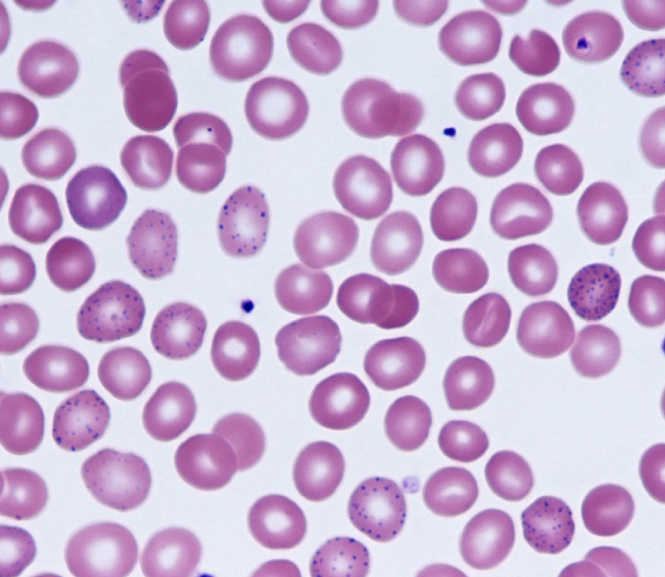 A 23-year-old man comes to the emergency department due to 4 days of cramping abdominal pain.  He has been feeling weak for the past 2 weeks.  He tried over-the-counter antacids without relief.  He is an industrial laborer with no significant medical history or known allergies.  The patient's parents have hypertension, and his siblings are healthy.  Temperature is 37.1 C (98.8 F) .  Physical examination is unremarkable.  The patient's peripheral blood smear is shown on the image below.   Which of the following is the most likely cause of this patient's symptoms? A) Acute intermittent porphyria B) Acute leukemia C) Atrophic gastritis D) Metal poisoning E) Non-Hodgkin lymphoma F) Poor nutrition