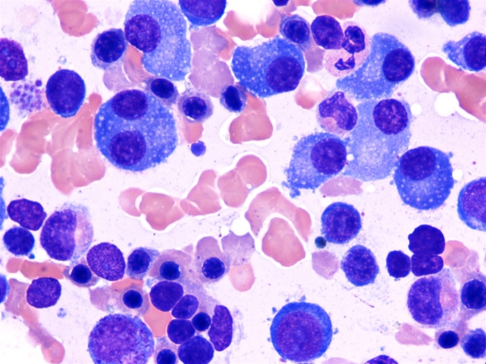 A 59-year-old man comes to the office due to 3 months of progressive fatigue and back pain.  The back pain occurs mainly with movement or positional changes.  Physical examination reveals midline tenderness over the middle and lower back.  Laboratory evaluation shows a hemoglobin level of 10.2 g/dL and serum calcium level of 12 mg/dL.  A bone marrow aspirate is performed, and the histopathologic findings are shown below.   This patient is at greatest risk for developing which of the following conditions? A) Amyloidosis B) Cardiac tamponade C) Hepatic failure D) Hyperthyroidism E) Meningeal carcinomatosis F) Splenic rupture