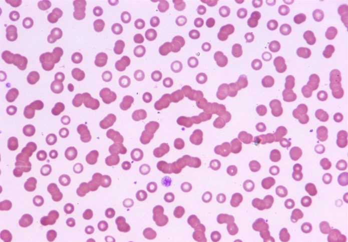 A 65-year-old man comes to the office due to 4 months of worsening fatigue.  The patient feels tired with simple household chores.  He has a 15-pack-year smoking history and drinks 2 or 3 beers daily.  Temperature is 37 C (98.6 F) , blood pressure is 134/86 mm Hg, and pulse is 76/min.  Physical examination reveals a late systolic ejection murmur with a soft S2.  The lungs are clear to auscultation.  The abdomen is soft and nontender with no hepatosplenomegaly.  There are no focal neurological deficits.  Laboratory testing reveals hemoglobin is 9 g/dL and mean corpuscular volume is 93 µm<sup>3</sup>.  Peripheral blood smear is shown below:   Which of the following best explains the observed erythrocyte findings in this patient? A) Chronic gastrointestinal blood loss B) Excessive cold agglutinin production C) Increased serum paraproteins D) Mechanical erythrocyte injury E) Nutritional vitamin B<sub>12</sub> deficiency