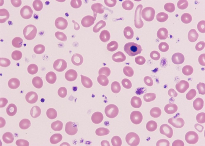 A 68-year-old man comes to the office due to severe fatigue for the last few months.  He has also had 6.8-kg (15-lb)  of unintentional weight loss over the same period.  The patient has no significant medical history and has not seen a physician in many years.  He takes no medications and does not use tobacco, alcohol, or illicit drugs.  Physical examination shows mucosal pallor with no scleral icterus.  The lungs are clear on auscultation, and heart sounds are normal.  Abdominal examination shows mild hepatomegaly and a markedly enlarged spleen.  Stool guaiac testing is negative.  Laboratory results show pancytopenia, and peripheral blood smear is shown below.   Bone marrow aspiration is attempted but yields no marrow, and a bone marrow biopsy is subsequently performed.  Which of the following findings is most likely to be observed in this patient's bone marrow? A) Diffusely fibrotic marrow with clusters of megakaryocytes B) Hypercellular marrow composed of clusters of plasma cells C) Increased staining for storage iron in marrow macrophages D) Marrow replaced by dysplastic cells of all 3 lineages E) Severely hypocellular marrow replaced by adipose cells