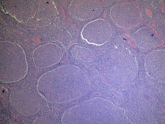 A 35-year-old man is being evaluated for nontender cervical lymphadenopathy that he first noticed while shaving.  A biopsy is performed, and a low-magnification image of the lymph node histology is shown below.   Cytogenetic analysis would most likely demonstrate which of the following patterns? A) BCL-2 overexpression B) BCR-ABL rearrangement C) C-MYC overexpression D) Constitutive tyrosine kinase activation E) N-MYC overexpression