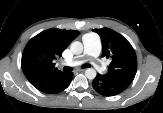 A 72-year-old man comes to the emergency department due to severe chest tightness and dyspnea that started 20 minutes ago at a family dinner.  He has never experienced similar symptoms before.  The patient's medical conditions include hypertension, hyperlipidemia, type 2 diabetes mellitus, and prostate cancer.  He takes multiple medications and has no drug allergies.  The patient smoked a pack of cigarettes daily for 30 years and stopped smoking 10 years ago.  Chest CT scan with contrast is shown in the image below.   Which of the following factors most likely contributed to this patient's current condition? A) Atherosclerosis B) Fluid overload C) Hypercoagulability D) Intimal tear E) Noninfectious vasculitis F) Pulmonary bleb rupture G) Pulmonary metastasis
