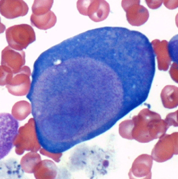 A 12-year-old girl is brought to the emergency department due to several days of worsening exertional dyspnea and lethargy.  The patient has a history of sickle cell disease and takes hydroxyurea.  Physical examination shows mucosal pallor and a systolic ejection murmur.  Laboratory studies reveal a hemoglobin level of 5.6 g/dL.  Bone marrow biopsy is performed and demonstrates decreased erythroid precursors and giant pronormoblasts containing inclusions, as shown below.   Which of the following is the most likely cause of this patient's current condition? A) Acute viral infection B) Dietary folate deficiency C) Medication adverse effect D) Secondary iron overload E) Toxic chemical exposure