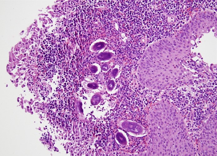 A 54-year-old Sudanese immigrant is evaluated for several months of intermittent dysuria and gross hematuria.  The patient notes that he passes blood at the end of urination but has no associated pain.  Cystoscopy reveals erythematous areas in the bladder mucosa.  Multiple biopsies are taken from the affected sites; histopathological findings are shown in the image below.   Which of the following most likely predisposed this patient to his current condition? A) Chronic urinary tract obstruction B) Contaminated water exposure C) Cytotoxic immunosuppressant use D) Extensive cigarette smoking E) Urea-splitting bacterial infection