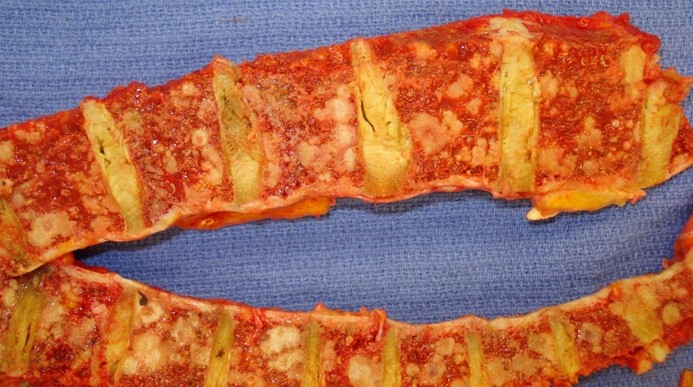 A 77-year-old man is brought to the emergency department due to acute-onset chest pain, shortness of breath, and syncope.  Medical history is significant for coronary artery disease, which was treated with right coronary artery stenting 5 years ago.  The patient develops cardiac arrest and resuscitation is unsuccessful.  Autopsy shows a large bilateral pulmonary embolism occluding the pulmonary trunk.  Further history obtained from the patient's wife indicates that he has had constant back pain over the past few months.  Autopsy of the vertebrae is shown in the image below:   Histologic examination of the bone lesions in this patient would most likely show which of the following? A) Aggregates of pleomorphic neoplastic cells containing coarse, brown pigment B) Cells with enlarged nuclei and prominent nucleoli forming irregular glands C) Effacement of bone marrow with clusters of plasmablasts and plasma cells D) Sheets of neoplastic cells with abundant clear cytoplasm E) Tumor cells showing a complex papillary pattern and psammoma bodies