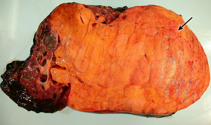 A 32-year-old woman is evaluated for pain and a palpable mass in the right flank.  Imaging studies reveal a large mass arising from the right kidney and similar smaller masses in the left kidney.  Surgery to remove the right-sided tumor along with the right kidney is performed; a cross section of the specimen is shown in the image below.   Histopathologic evaluation shows that the mass is composed of fat, smooth muscle, and blood vessels.  This patient is most likely to have which of the following additional findings? A) Bilateral acoustic neuromas B) Brain hamartomas and ash-leaf skin patches C) Capillary angiomas of the face and choroid D) Cerebellar hemangioblastomas and liver cysts E) Multiple peripheral neurofibromas and café-au-lait skin spots F) Multiple telangiectasias of the skin and mucosa