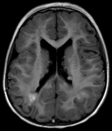 A 3-year-old boy is being evaluated for recurrent generalized seizures and developmental delay.  Physical examination is notable for scattered hypopigmented skin patches.  MRI of the head reveals multiple masses, most of which line the ependymal surfaces of the lateral ventricles, and some are calcified, as shown in the below image.   Which of the following is the most likely underlying cause of this patient's brain lesions? A) Benign hamartoma formation B) Lysosomal metabolite accumulation C) Malignant lymphoid proliferation D) Mycobacterial meningeal invasion E) Tapeworm larvae migration