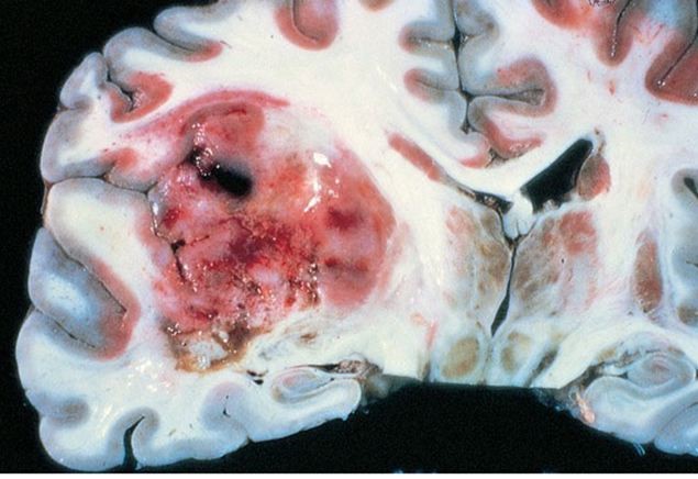 A 62-year-old man is brought to the emergency department after a new-onset, generalized tonic-clonic seizure.  His wife reports that for the past several weeks he has been having episodic headaches, nausea, and progressive weakness.  The headaches are particularly worse at night and occasionally awaken him from sleep.  His other medical problems include well-controlled hypertension and osteoarthritis.  On physical examination, the patient is postictal but follows simple commands.  He is admitted to the hospital for further evaluation but dies several days later due to aspiration pneumonia and septic shock.  A brain section obtained during postmortem examination is shown in the image below.   This patient most likely had which of the following conditions? A) Brain metastasis B) Glioblastoma C) Meningioma D) Oligodendroglioma E) Primary brain lymphoma F) Schwannoma