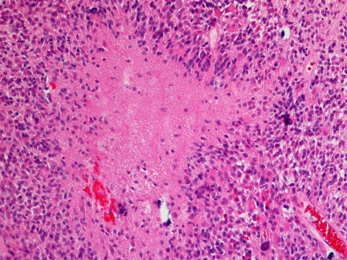 A 64-year-old man is being evaluated for nausea and a new-onset headache that worsens when he bends over.  Brain imaging shows a hemispheric cerebral mass that is subsequently biopsied.  Light microscopy of the tissue specimen is shown in the image below.   Which of the following histologic findings is most characteristic of this lesion? A) Cyst formation and rare mitoses B) Inflammatory cell infiltrate and reticulin deposits C) Microscopic laminar calcium deposition D) Necrosis and vascular proliferation E) Proliferating cells surrounding blood vessels