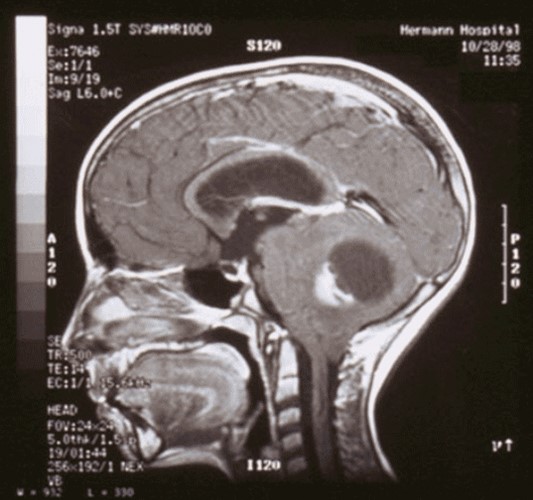 A 12-year-old boy is brought to the office by his mother due to headaches and gait instability.  His symptoms began several months ago and have progressively worsened.  MRI of the brain is shown in the image below.   Which of the following is the most likely diagnosis? A) Ependymoma B) Glioblastoma multiforme C) Medulloblastoma D) Oligodendroglioma E) Pilocytic astrocytoma