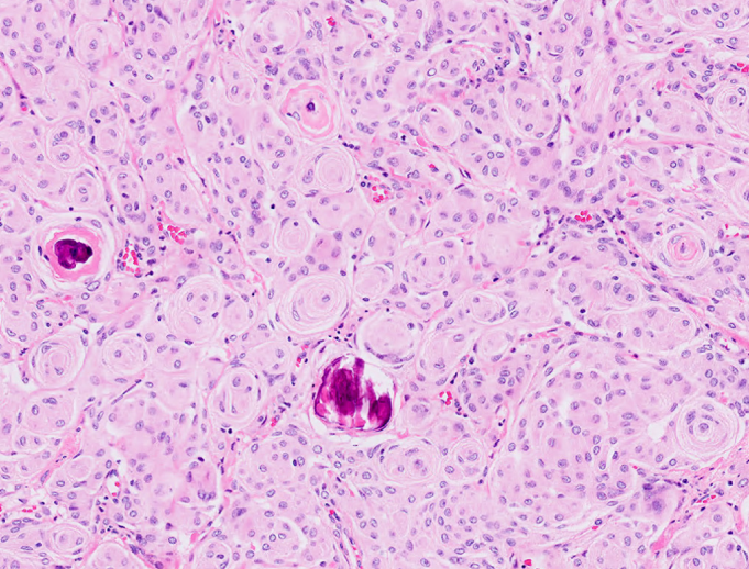 A 45-year-old woman is brought to the emergency department after an episode during which she abruptly lost consciousness and had rhythmic jerking movements of the limbs followed by a period of confusion.  The patient has had mild daily headaches associated with nausea that have progressed over the past 2 years.  The headaches are worse at night and occasionally awaken her.  The patient reports no head trauma, visual changes, weakness, numbness, or difficulty swallowing or speaking.  She does not use alcohol or illicit drugs.  There is no family history of seizures.  An intracranial mass is discovered on neuroimaging and a biopsy of the mass is shown in the image below.   Which of the following is the most likely diagnosis? A) Craniopharyngioma B) Ependymoma C) Glioblastoma D) Medulloblastoma E) Meningioma F) Oligodendroglioma G) Pilocytic astrocytoma H) Schwannoma