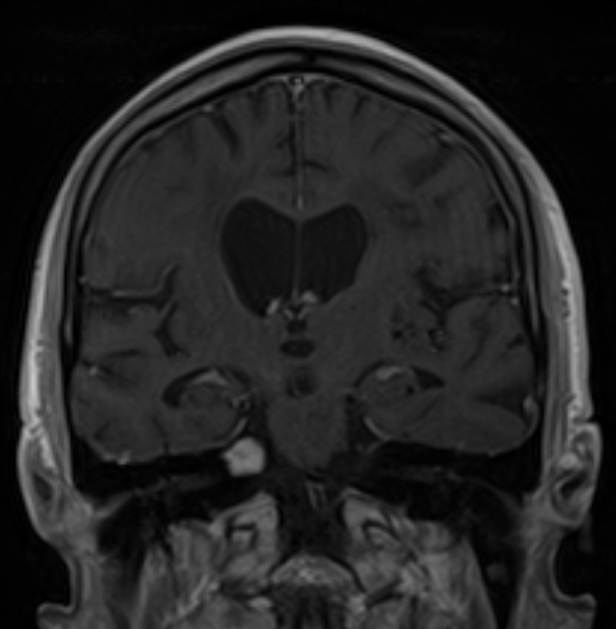 A 55-year-old woman comes to the physician due to a 4-month history of progressive hearing loss in her right ear.  Vital signs are within normal limits.  Inspection of the external ear canals and tympanic membranes shows no abnormalities.  Neurologic examination shows decreased hearing in the right ear; hearing in the left ear is normal.  MRI of the head with contrast is shown in the image below:   Which of the following is the most likely diagnosis? A) Arteriovenous malformation B) Astrocytoma C) Ependymoma D) Medulloblastoma E) Meningioma