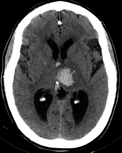A 60-year-old professor is brought to the emergency department after developing right-sided weakness and numbness during a lecture an hour ago.  He also has nausea and confusion.  The patient smoked a pack of cigarettes daily for 20 years but quit 10 years ago.  He does not drink alcohol.  His father died of myocardial infarction at age 70.  Blood pressure is 190/100 mm Hg, and pulse is 60 /min.  On physical examination, there are no signs of head trauma.  There is diminished right-sided strength (1/5)  and an upgoing plantar reflex.  Brain CT without contrast is obtained immediately.  The image is shown below.   Which of the following is the most likely cause of this patient's condition? A) Arteriovenous malformation B) Cardiac embolism C) Carotid artery atherosclerosis D) Cerebral amyloid angiopathy E) Charcot-Bouchard aneurysm F) Hypertensive encephalopathy G) Hypoxic encephalopathy H) Large vessel arteritis I) Saccular aneurysm