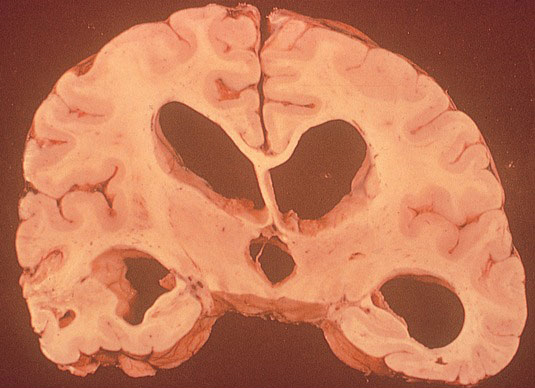 A gross brain section of a 54-year-old male who suffered from severe tuberculous meningitis is shown below.   This patient's condition is most likely related to impaired function of which of the following? A) Emissary veins B) Arachnoid trabeculae C) Arachnoid granulations D) Choroid plexus E) Dural septae F) Communicating arteries