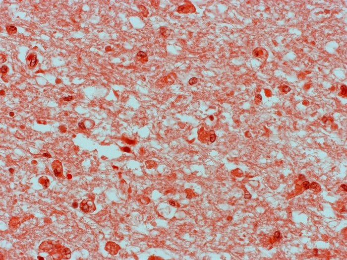 A 56-year-old man passes away in the hospital from problems brought on by aspiration. Five days ago, the patient was hospitalized with right-sided weakness, sensory loss, and issues speaking and swallowing. The left frontoparietal region was hypodensified according to a CT scan. A slice of loose, spongy tissue from the aberrant brain region is taken for autopsy investigation. Below are histologic results following lipid staining.   The cells most intensely stained in this patient's brain specimen represent which of the following cell types? A) Astrocytes B) Ependymal cells C) Fibroblasts D) Microglial cells E) Neutrophils F) Schwann cells