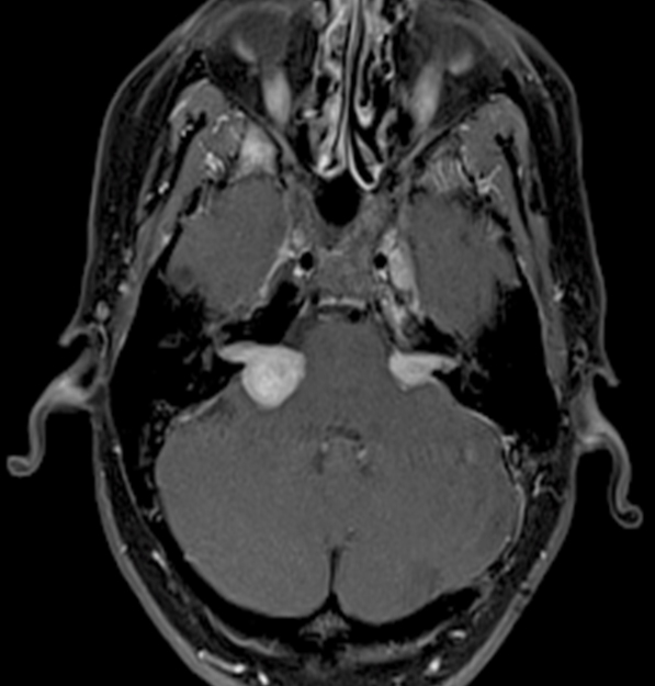 A 24-year-old man comes to the physician with complaints of tinnitus, vertigo, and hearing loss.  A contrast-enhanced, T1-weighted image of his brain is shown below.   This patient's condition is most likely associated with a mutation involving which of the following genes? A) APC on chromosome 5 B) NF1 on chromosome 17 C) NF2 on chromosome 22 D) p53 on chromosome 17 E) RB1 on chromosome 13 F) VHL on chromosome 3