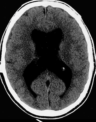 A 64-year-old woman is evaluated for progressive gait disturbance over the last 2 years.  The patient feels her feet are  stuck on the floor  and that she is unsteady while walking.  She also recently began experiencing urinary urgency and has wet herself several times due to difficulty getting to the bathroom on time.  The patient stopped working 6 months ago because of difficulty concentrating, and she has also lost interest in her hobbies and social activities.  She has had no tremor, visual changes, headaches, nausea, or vomiting.  The patient has a remote history of closed traumatic brain injury.  Vital signs are within normal limits.  On physical examination, lower extremity tone and deep tendon reflexes are increased.  Sensation to light touch, pain, and vibration are normal.  The patient's gait is slow with small steps and a wide base.  CT scan of the head is shown below.   Which of the following is the most likely diagnosis? A) Alzheimer disease B) Frontotemporal dementia C) Idiopathic Parkinson disease D) Major depressive disorder E) Normal pressure hydrocephalus F) Obstructive hydrocephalus G) Vitamin B<sub>12</sub> deficiency