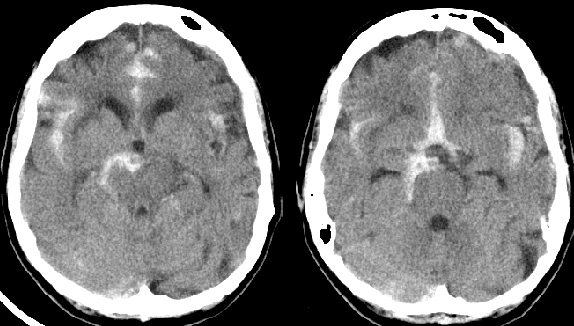 A 43-year-old woman is brought to the emergency department because of a sudden and severe headache.  Her blood pressure is 160/90 mm Hg and pulse is 90/min.  Her pupils are symmetric and reactive to light and she can move all four extremities without weakness.  CT of her head is shown below.   This patient's condition is most likely caused by which of the following? A) Carotid artery atherosclerosis B) Cardiac embolism C) Hypoxic encephalopathy D) Hypertensive encephalopathy E) Large vessel arteritis F) Hypertensive arteriolar sclerosis G) Cerebral amyloid angiopathy H) Rupture of saccular aneurysm I) Charcot-Bouchard aneurysm