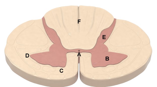A 20-year-old woman comes to the physician because of multiple burns on her hands.  She says that she gets burned quite often when she cooks, particularly while operating the oven.  She also has burned herself when picking up her morning cup of coffee and when testing the water temperature in the shower.  The patient is concerned because she cannot feel when objects are  really hot  and often does not notice that she has burns until she looks at her hands.  She has no significant past medical history, no recent illnesses, and no sick contacts.  Her surgical history is significant only for removal of impacted wisdom teeth 1 year ago.  The patient has never smoked, drinks alcohol occasionally, and does not use illicit drugs.  Her family history is significant for multiple sclerosis in her mother.  Examination shows diminished pinprick and temperature sensation across the upper back, shoulders, and arms bilaterally.  Light touch, position, and vibration sense are preserved.  Examination of the lower extremities is unremarkable.  Damage to which of the following spinal cord areas is most likely responsible for this patient's symptoms?   A) A B) B C) C D) D E) E F) F