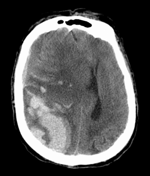 A 45-year-old man is brought to the emergency department after sustaining a traumatic head injury in a motor vehicle collision.  The patient was found unresponsive and had several generalized tonic-clonic seizures during transport.  Medical history includes hypertension as well as alcohol and cocaine misuse.  Temperature is 36.7 C (98.1 F) , blood pressure is 170/96 mm Hg, pulse is 50/min, and respirations are 10/min.  Pulse oximetry shows 98% on mechanical ventilation with 50% oxygen.  On examination, the patient is comatose with midpositioned and fixed pupils and rigid extension of the upper and lower extremities.  Noncontrast CT scan of the head is shown in the image below:   Damage to which of the following structures is the most likely explanation for this patient's abnormal posturing? A) Cerebellar vermis B) Cerebral hemisphere C) Cervical spinal cord D) Internal capsule E) Pons F) Substantia nigra G) Thalamus