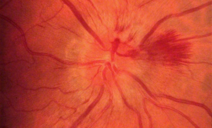 A 62-year-old man with a history of poor medical follow-up comes to the office due to difficulty seeing.  He has had blurry vision for the last 2 weeks.  A day ago, he noticed a shadow develop suddenly across the visual field of his right eye.  The patient has had no recent headaches, double vision, vertigo, light sensitivity, or nausea.  On examination, pupils are equal and reactive to light.  Visual field testing by confrontation reveals patchy loss of vision.  A flame-shaped retinal hemorrhage in the right eye is noted on funduscopic examination, as shown in the image below.   Which of the following is the most likely cause of his visual disturbance? A) Central retinal artery occlusion B) Cigarette smoking C) Closed-angle glaucoma D) Giant cell arteritis E) Hyperlipidemia F) Hypertension G) Migraine H) Thyroid eye disease