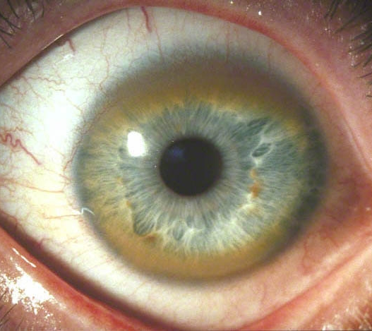 Physical examination of a 23-year-old man diagnosed with chronic hepatitis shows corneal changes that are visible to the naked eye, as shown in the image below.   This patient is most likely to have which of the following conditions? A) Pulmonary emphysema B) Diabetes mellitus C) Basal ganglia atrophy D) Renal cancer E) Hypertrophic cardiomyopathy F) Congenital deafness