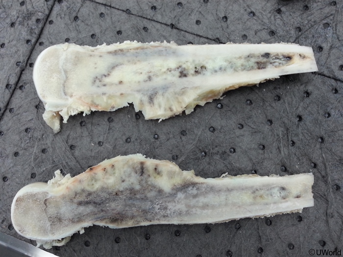 An 18-year-old man is evaluated due to 3 months of lower extremity pain.  The pain is persistent and present both day and night.  He has no fever, chills, or history of leg trauma.  Imaging shows an expansile lesion of the distal femur.  Surgical resection is performed, and the specimen is shown below.   Mutations involving which of the following genes are most likely present in this patient? A) BRAF B) HER2 C) KRAS D) RB1 E) RET