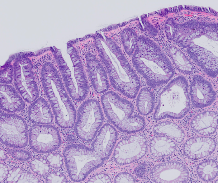 A 50-year-old man is scheduled to undergo a colonoscopy for routine colorectal cancer screening.  He has no abdominal pain, gross blood in the stool, constipation, change in stool caliber, or unintentional weight loss.  He also has no family history of colon cancer.  The procedure is uncomplicated, but the patient is found to have a small mucosal lesion (~1 cm)  in his sigmoid colon.  The lesion is biopsied and its histology is shown in the image below.   The pathogenesis of this patient's lesion most likely began with a mutation involving which of the following genes? A) APC B) DCC C) K-RAS D) MSH2 E) p53