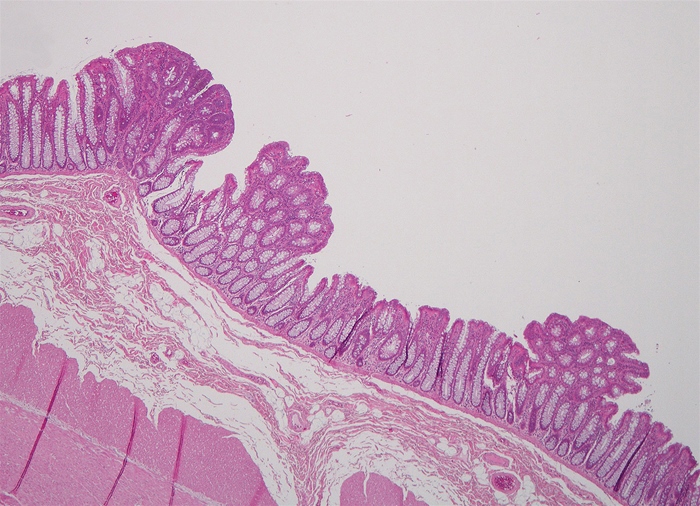 A 21-year-old woman is hospitalized for elective subtotal colectomy with ileo-rectal anastomosis due to abnormal colonoscopic findings.  She underwent screening colonoscopy because of family history of colon cancer.  Her maternal grandfather died of metastatic colon cancer, and her mother was also recently diagnosed with colon cancer.  The patient has no other medical problems, takes no medications, and does not use tobacco, alcohol, or illicit drugs.  The surgery is performed with no operative complications.  Numerous lesions are present throughout the resected colon, some of which are shown in the histopathology exhibit below.   Genetic testing is most likely to reveal a germline mutation resulting in which of the following effects? A) Abnormality of RAS signaling protein B) Absence of regulatory TP53 protein C) Defective repair of DNA mismatches D) Increase in cellular telomerase activity E) Loss of functional APC protein