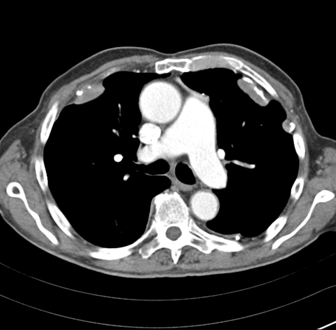 A 64-year-old man is brought to the emergency department after a motor vehicle collision in which his chest hit the steering wheel.  The patient has no prior medical conditions and takes no medications.  Temperature is 36.7 C (98 F) , blood pressure is 132/78 mm Hg, pulse is 76/min, and respirations are 14/min.  Physical examination shows mild tenderness over the lower right chest.  Imaging of the neck and chest reveals no fractures or dislocations.  However, the chest CT scan reveals pleural opacities as shown below.   These abnormal findings are most likely to occur in a patient with which of the following occupational histories? A) Aerospace manufacturing B) Coal mining C) Insulation manufacturing D) Hay farming E) Petroleum processing/refining F) Sandblasting