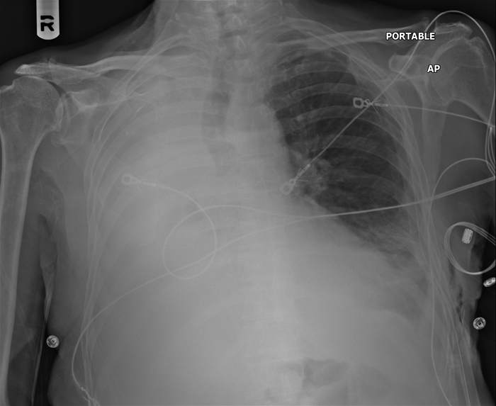 A 65-year-old man with a long history of smoking comes to the emergency department with shortness of breath and a chronic mild cough.  His symptoms progressed gradually over the last week and today have become suddenly worse.  The patient has hypertension that is controlled with hydrochlorothiazide.  On examination, his temperature is 36.7 C (98 F) , blood pressure is 135/85 mm Hg, pulse is 94/min, and respirations are 24/min.  Pulse oximetry shows 86% on room air.  He has decreased breath sounds over the right chest.  His chest x-ray is shown in the image below.   Which of the following is the most likely cause of this patient's radiographic findings? A) Fluid in the alveolar spaces B) Interstitial lung disease C) Pleural space disease D) Pulmonary vascular disease E) Right mainstem bronchus obstruction