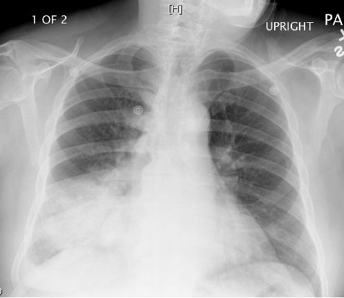A 64-year-old man is evaluated for worsening cough and shortness of breath.  The patient has a history of hypertension and type 2 diabetes mellitus.  He smokes a pack of cigarettes daily and drinks alcohol occasionally.  Temperature is 38 C (100.4 F) , blood pressure is 140/82 mm Hg, and pulse is 92/min.  Lung auscultation reveals abnormal breath sounds.  Chest x-ray is shown below.   Which of the following is the most likely cause of the observed pulmonary findings in this patient? A) Elevated pulmonary capillary hydrostatic pressure B) Exaggerated reactivity and inflammation of the airways C) Excessive fibroblast proliferation and extracellular matrix deposition D) Leakage of protein-rich fluid in the alveolar airspaces E) Mucous gland hyperplasia and inflammation in the large airways