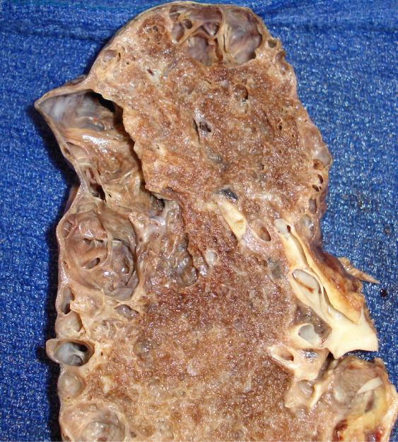 A 67-year-old man develops severe respiratory distress and collapses.  The emergency medical team finds the patient unresponsive with no pulse and he is unable to be revived despite cardiopulmonary resuscitation.  A photograph of the lung as seen at autopsy is shown below.   Which of the following underlying histopathological changes are most likely to be seen within this patient's lungs? A) Ferruginous bodies embedded within interstitial fibrous tissue B) Hemosiderin-laden macrophages within congested airways C) Interalveolar septal destruction with bronchial wall inflammation D) Multinucleated giant cells surrounding caseating granulomas E) Necrotizing arteritis with adjacent palisading epithelioid histiocytes F) Patchy interstitial fibrosis with the presence of fibroblastic foci