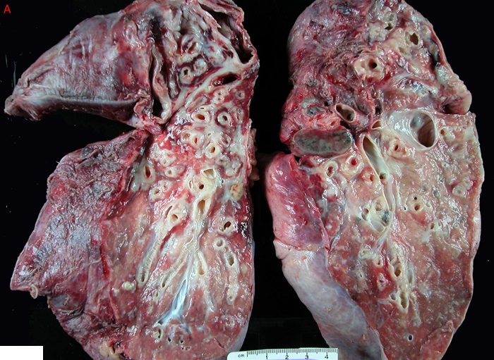 A 17-year-old girl is brought to the emergency department due to hemoptysis and severe respiratory distress.  The patient has been on several oral antibiotics for pneumonia over the past week and has required numerous similar treatments in the past.  She has been coughing up blood for the past day, which has become progressively worse.  Temperature is 37.0 C (98.6 F) , blood pressure is 90/60 mm Hg, pulse is 120/min, and respirations are 42/min.  Pulmonary examination reveals diffusely reduced air flow, rales, and intercostal retractions.  Copious red blood is produced while coughing during the examination and progresses rapidly.  Despite aggressive management, the patient ultimately expires.  An autopsy is performed and a gross lung specimen is shown in the image below:   Which of the following is the most likely etiology of this patient's hemoptysis? A) Bleeding from hypertrophied bronchial arteries B) Blood loss from hypertrophied pulmonary arteries C) Diffuse alveolar hemorrhage due to vasculitis D) Formation of a fistula between the tracheobronchial tree and aorta E) Hemorrhage from a highly vascular endobronchial tumor