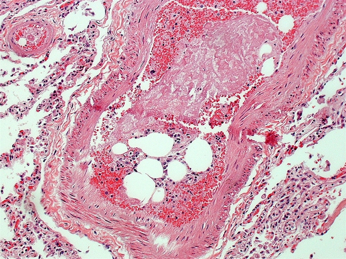 A 34-year-old man is hospitalized due to trauma sustained during a motor vehicle collision.  He subsequently develops worsening shortness of breath and confusion and dies despite appropriate management.  Autopsy examination shows scattered petechiae on the anterior thorax.  Microscopic evaluation of his pulmonary vessels reveals the findings shown below.   Which of the following most likely predisposed this patient to developing the observed histopathologic abnormality? A) Aspiration of gastric contents B) Left ventricular dysfunction C) Long-bone fracture D) Severe systemic infection E) Thrombosis in the deep veins