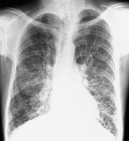 A 58-year-old man comes to the office due to exertional dyspnea and cough.  His symptoms started 6 months ago and have progressively worsened.  Other medical problems include recurrent pyelonephritis, peptic ulcer disease, and rheumatoid arthritis.  The patient had taken a medication for rheumatoid arthritis for many years but stopped a year ago, as the drug failed to improve his worsening hand arthritis.  He does not use tobacco, alcohol, or illicit drugs.  Physical examination shows joint disease consistent with rheumatoid arthritis.  Chest x-ray is shown in the image below.   Which of the following is the most likely explanation for this patient's pulmonary symptoms? A) Bilateral atelectasis B) Left ventricular failure C) Obstructive lung disease D) Pulmonary fibrosis E) Pulmonary hypertension