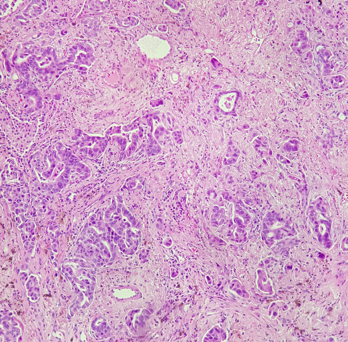 A 72-year-old woman comes to the office due to a persistent cough over the last 2 months that is occasionally associated with scant, white sputum.  She has also lost 4.5 kg (10 lb)  since the onset of her symptoms.  The patient is an ex-smoker with a 25-pack-year history.  She was diagnosed with mild chronic obstructive pulmonary disease several years ago, and she uses albuterol as needed for episodes of wheezing and shortness of breath.  Physical examination shows scattered wheezes bilaterally.  Chest CT scan reveals a mass in the right lung.  Light microscopy of the mass is shown below:   Which of the following is the most likely diagnosis? A) Adenocarcinoma of the lung B) Mesothelioma C) Pulmonary tuberculosis D) Small cell lung cancer E) Squamous cell lung cancer