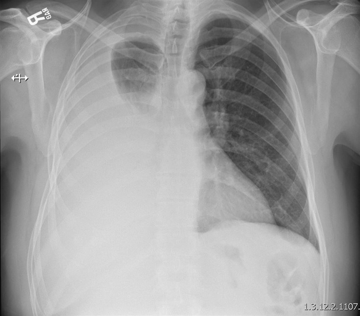 A 66-year-old man comes to the office due to increasing shortness of breath over the past 3 weeks.  He has had a nonproductive cough for several months, which he attributes to allergies, but also notes a 9-kg (20-lb) , unintentional weight loss over this time.  The patient has no prior medical conditions and takes no medications.  He has a 50-pack-year smoking history.  Temperature is 36.7 C (98 F) , blood pressure is 120/80 mm Hg, pulse is 72/min, and respirations are 18/min.  Chest x-ray is shown below.   Which of the following would be the expected physical examination finding over the right lower chest? A) Bronchial breath sounds B) Decreased tactile fremitus C) Fine inspiratory crackles D) Focal, monophasic wheeze E) Increased resonance on percussion F) Rhonchi that clear with cough
