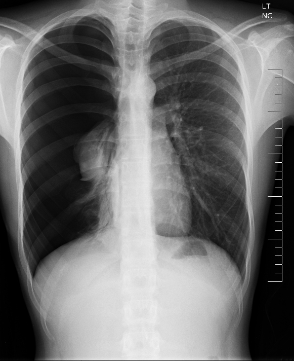 An 18-year-old man comes to the emergency department with sudden-onset right-sided chest pain and dyspnea.  The patient was at home watching a football game on television when his symptoms abruptly started.  He now has pain with deep breaths.  He has no other medical problems and takes no medications.  The patient has smoked a pack of cigarettes daily for the past 2 years.  His respirations are 24/min.  Physical examination shows a thin, tall patient in acute distress.  The right side of the chest is hyperresonant to percussion and lacks audible breath sounds.  His chest x-ray is shown below.   Which of the following conditions most likely led to this patient's presentation? A) Apical subpleural blebs B) Centriacinar emphysema C) Compensatory hyperinflation D) Obstructive hyperinflation E) Panacinar emphysema