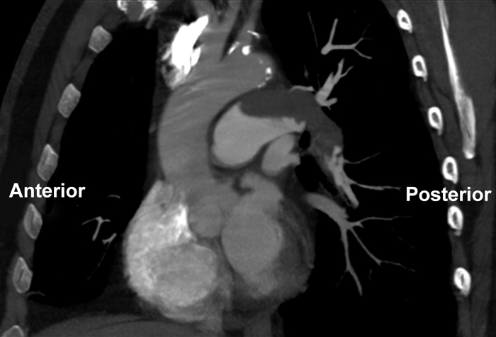 A 64-year-old woman is hospitalized after injuring her right hip when she slipped on ice while carrying groceries.  X-ray reveals a right femoral neck fracture, and the patient undergoes a total hip arthroplasty with no operative complications.  Two days after surgery, the patient develops acute hemodynamic decompensation.  A contrast-enhanced CT scan of the chest is immediately obtained; a sagittal view is shown below.   In-hospital administration of which of the following is most appropriate for reducing the risk of patients developing this complication? A) Beta-adrenergic antagonist B) Fresh-frozen plasma C) Intravenous hydration D) Low-molecular-weight heparin E) Perioperative antibiotics F) Tissue plasminogen activator