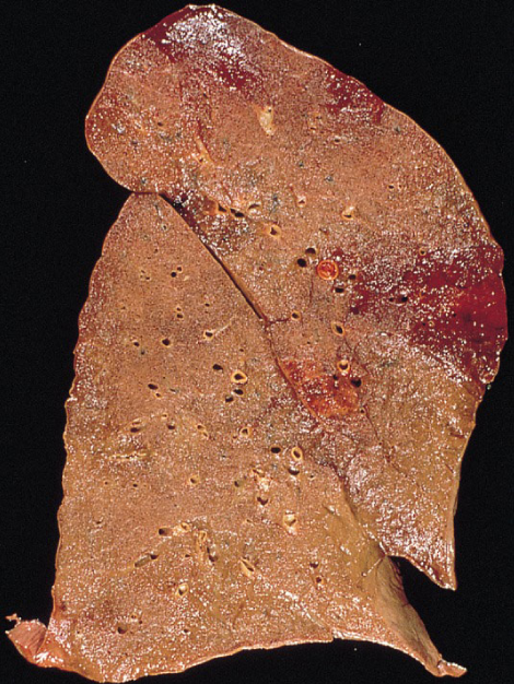 A 33-year-old man comes to the emergency department due to 3 days of shortness of breath, profound fatigue, and chills.  The patient has a history of intravenous drug use.  He was enrolled in a methadone program but admits to relapsing last week.  Temperature is 40 C (104 F) , blood pressure is 75/40 mm Hg, pulse is 122/min and regular, and respirations are 40/min.  He is admitted to the intensive care unit but dies despite treatment efforts.  Lung autopsy findings are shown in the image below.   Which of the following is the most likely diagnosis in this patient? A) Miliary tuberculosis B) Mycotic aortic aneurysm C) Severe small airway obstruction D) Tricuspid valve endocarditis E) Venous thromboembolism