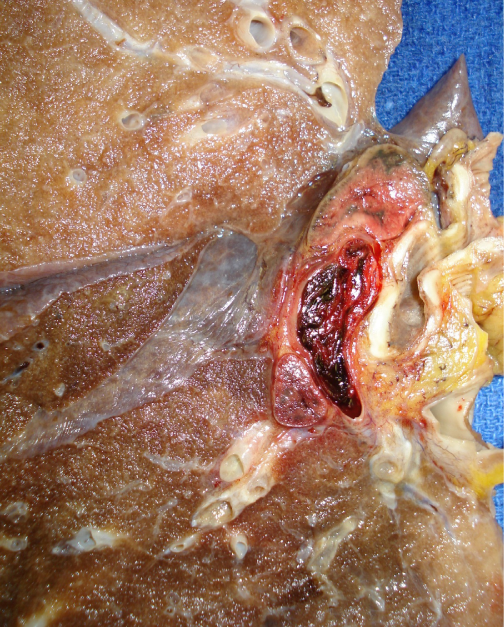 A 62-year-old man is found dead in his hotel room.  He was traveling for work and had checked into the hotel the night prior.  No other history is available.  Autopsy examination is performed; the lung findings shown below are determined to be the cause of death.   Which of the following is the most likely inciting event that led to this patient's death? A) Coronary atheromatous plaque rupture B) Deep femoral vein thrombus formation C) Malignancy-induced bronchial bleeding D) Malignancy-induced bronchial obstruction E) Sleep-related upper airway obstruction