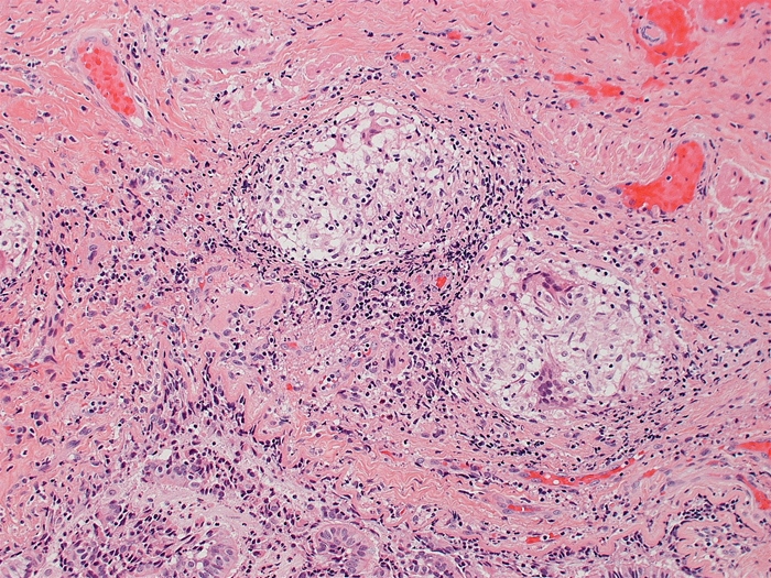 A 35-year-old woman comes to the office due to 3 months of progressive dyspnea on exertion, nonproductive cough, and fatigue.  She has a history of seasonal allergies for which she takes over-the-counter antihistamines.  The patient ascribes her symptoms to smoking cigarettes and has cut down from a pack to 3 or 4 cigarettes daily.  Her mother has rheumatoid arthritis.  CT-guided lung biopsy is performed; findings are shown in the image below.   This patient most likely has which of the following conditions? A) Bronchopulmonary aspergillosis B) Churg-Strauss syndrome C) Desquamative interstitial pneumonia D) Hodgkin lymphoma E) Idiopathic pulmonary fibrosis F) Progressive systemic sclerosis G) Pulmonary alveolar proteinosis H) Sarcoidosis I) Small cell lung carcinoma