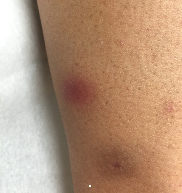 A 36-year-old woman comes to the office due to arthralgias and nodules on her legs.  She has no prior medical conditions and takes no medications.  On physical examination, there is moderate hepatomegaly.  A representative skin rash is shown in the image below.  The lesions are tender and present predominantly on the anterior surface of the lower extremities.   Chest x-ray demonstrates enlarged hilar lymph nodes, and laboratory testing reveals an elevated ACE level.  Which of the following would most likely be found on liver biopsy in this patient? A) Centrilobular necrosis B) Fatty change C) Nodular regeneration D) Periportal fibrosis E) Portal inflammation F) Scattered granulomas