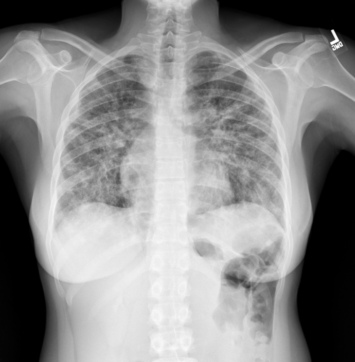 A 35-year-old woman comes to the emergency department due to fatigue, exertional dyspnea, and cough.  She has had subjective fevers but no upper respiratory symptoms, and no family members have had a similar illness.  Medical history is unremarkable, and the patient does not use tobacco.  Temperature is 37.5 C (99.5 F) , blood pressure is 118/75 mm Hg, pulse is 90/min, and respirations are 22/min.  Pulmonary examination shows normal air exchange with scattered crackles and no wheezes.  The patient also has nontender cervical lymphadenopathy.  Serum chemistry shows a calcium level of 12.0 mg/dL.  Chest x-ray demonstrates scattered nodules and parenchymal infiltrates, as shown in the image below.   Lymph node biopsy reveals noncaseating granulomas.  Which of the following is the most likely cause of the elevated calcium level in this patient? A) Accelerated bone turnover B) Activated macrophages C) Destruction of bone tissue D) Increased parathyroid hormone secretion E) Phosphate retention