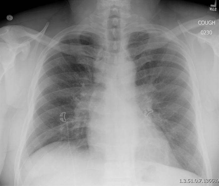 A 43-year-old man comes to the office due to malaise, night sweats, and cough for the past several weeks.  He has also lost 4.5 kg (10 lb)  over the past 4 months.  The patient has no appreciable medical history and has not traveled recently.  He has spent the last 10 years working as a respiratory therapist at an urban hospital.  Chest x-ray is shown below.   A palpable lymph node in the supraclavicular bed is biopsied and pathology reveals well-formed, noncaseating granulomas.  Which of the following is the most likely diagnosis? A) HIV infection B) Hodgkin lymphoma C) Metastatic adenocarcinoma of the lung D) Metastatic squamous cell carcinoma of the lung E) Mycobacterium avium complex F) Mycobacterium tuberculosis G) Sarcoidosis