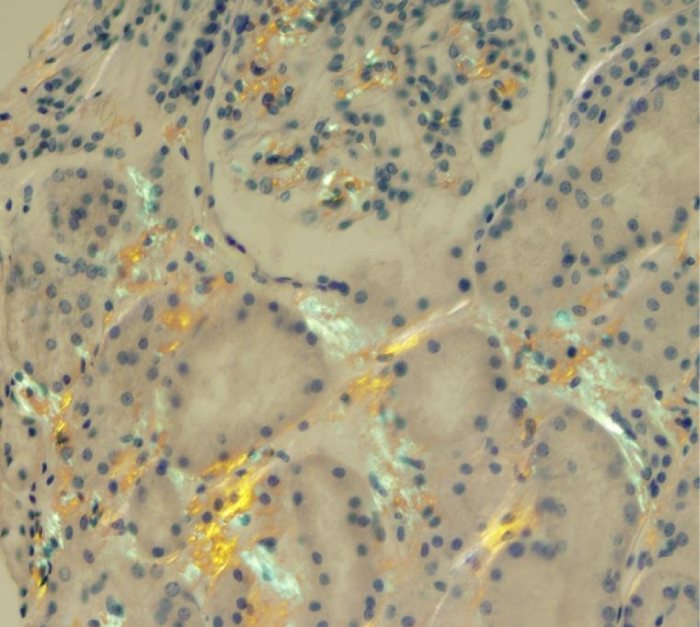 A 55-year-old man is evaluated due to worsening fatigue and exertional shortness of breath.  He has no chronic medical conditions and takes no medications.  Physical examination shows facial puffiness and bilateral lower extremity edema.  Urinalysis shows 3+ proteinuria.  Kidney biopsy findings with special staining under polarized light are shown on the image below:   Which of the following tests would be most helpful for establishing a specific diagnosis in this patient? A) 24-hour urinary copper excretion B) 24-hour urinary uric acid excretion C) Serum protein electrophoresis D) Serum total bilirubin concentration E) Serum total body iron content